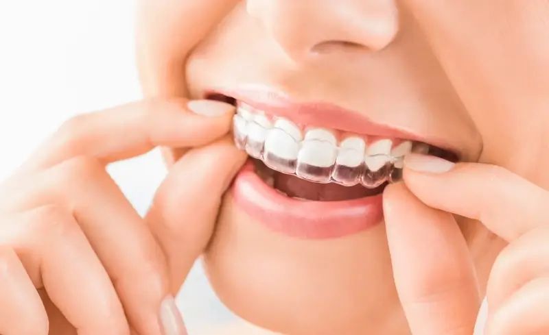 Aparat nakładkowy Invisalign