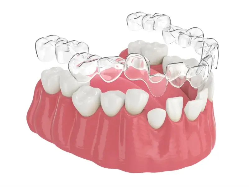 Czy noszenie nakładek Invisalign boli?
